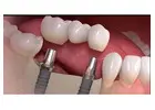 Same day crown Las Vegas by functionalaestheticdentistry.com