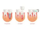 Dental implants Summerlin by functionalaestheticdentistry.com