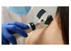 Say Goodbye to Skin Tags: Expert Removal Services in Harrow