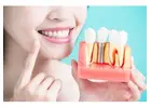 Dental Implants Service in Kennesaw