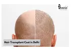Hair Transplant Cost in Delhi | Dermatrico